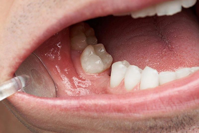 Mất răng hàm gây ra những ảnh hưởng nghiêm trọng tới sức khoẻ và thẩm mỹ