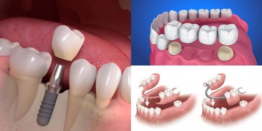 Trồng răng hàm giả với nhiều phương pháp
