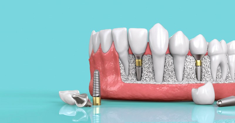 Sau khi cấy ghép răng Implant 1 thời gian bạn có thể khôi phục chức năng ăn nhai như bình thường