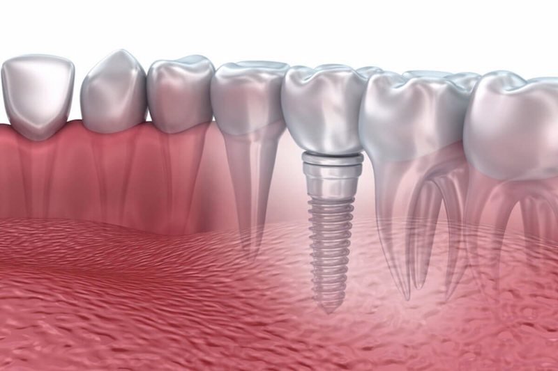 Trồng răng Implnat đúng cách sẽ giúp đảm bảo chức năng thẩm mỹ và chức năng ăn nhai như răng thật