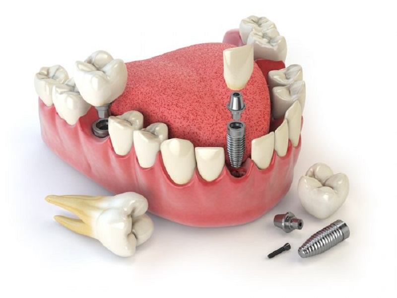 Trồng răng implant mất bao lâu có thể hoàn thành được