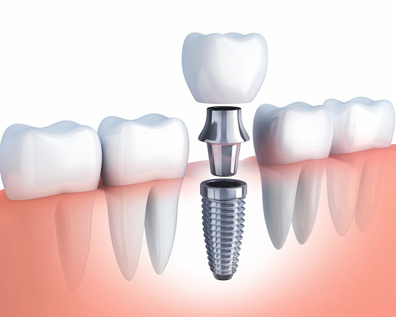 Các bộ phận chính cấu tạo nên răng Impalnt