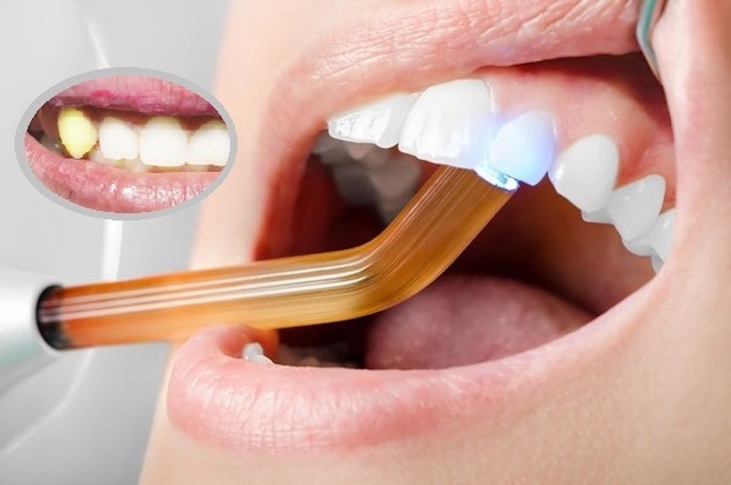 Trồng răng khểnh bằng phương pháp đắp trám composite không gây đau nhức