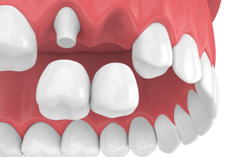 Cầu răng sứ là một trong những kỹ thuật phục hình răng khểnh phổ biến nhất hiện nay