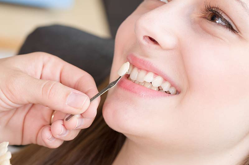 Sở hữu chiếc răng khểnh dán sứ giúp bạn có được vẻ đẹp thanh tú, tự nhiên