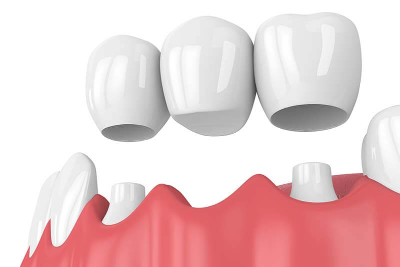 Phương pháp trồng răng nanh bằng cầu răng sứ được khá nhiều người lựa chọn