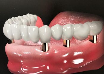 Sử dụng răng Implat có nhiều ưu điểm hơn so với hàm tháo lắp