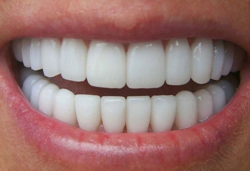Trồng răng nguyên hàm đúng quy trình mới mang lại hiệu quả cao