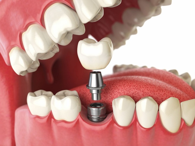 Cấy ghép Implant là phương pháp trồng răng sứ thẩm mỹ cao cấp và hiện đại nhất hiện nay