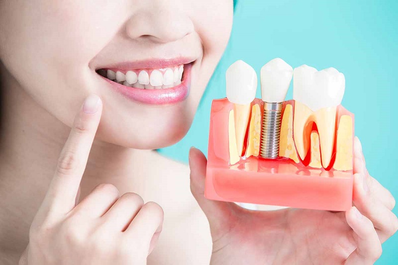 Trồng răng sứ là phương pháp nha khoa thẩm mỹ hiện đại, nhiều người lựa chọn