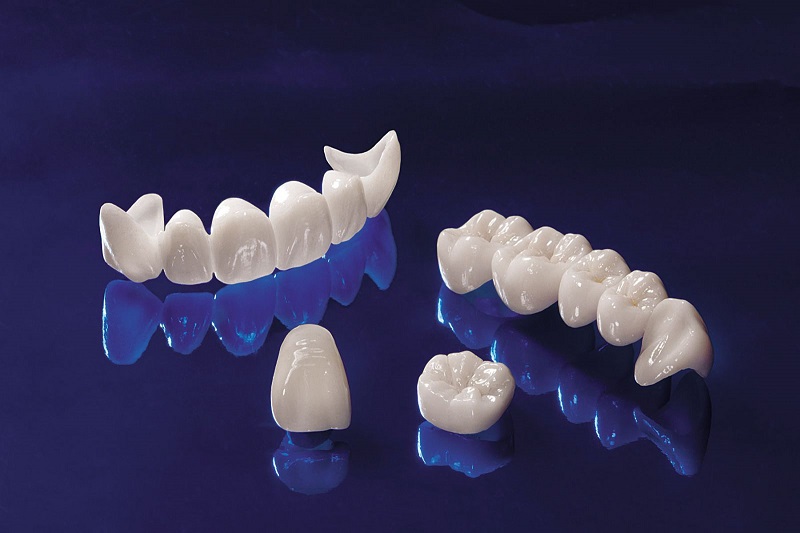 Răng toàn sứ có tính thẩm mỹ cao và chất lượng ổn định nhất