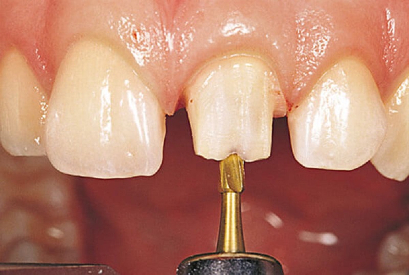 Rất nhiều trường hợp, sau khi trồng răng sứ có triệu chứng đau nhức.