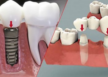 Cấy Implant và cầu răng sứ là 2 phương pháp trồng răng sứ cố định được sử dụng rộng rãi