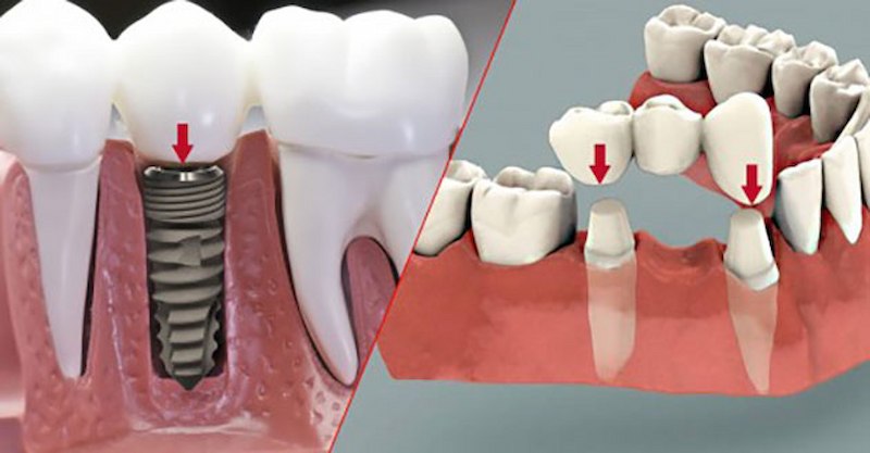 Cấy Implant và cầu răng sứ là 2 phương pháp trồng răng sứ cố định được sử dụng rộng rãi