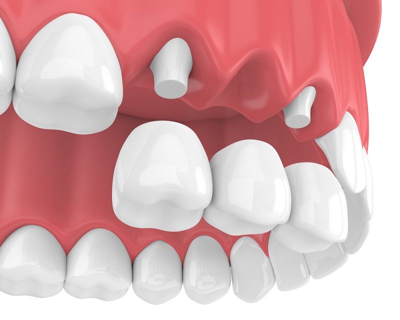 Răng sứ trồng gây áp lực lên những chiếc răng thật