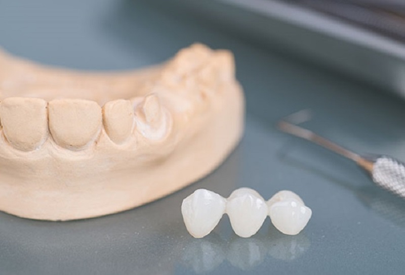 Trồng răng sứ là phương pháp giúp người bị mất răng có thể khôi phục khả năng ăn nhai, tính thẩm mỹ