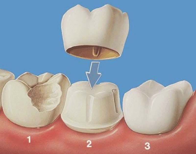 Trồng răng sứ giá bao nhiêu 1 chiếc? Phụ thuộc vào yếu tố nào?