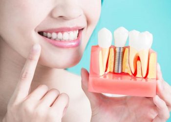 Trồng răng sứ giá bao nhiêu 1 chiếc - Phụ thuộc vào chất liệu răng sứ