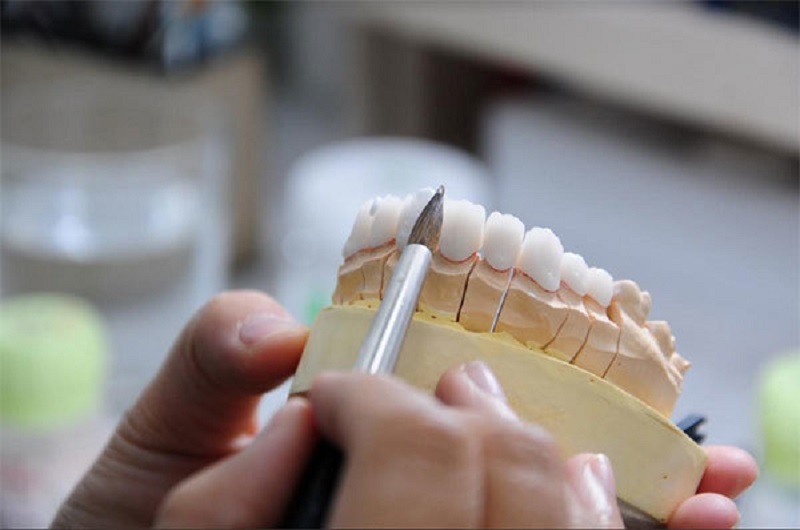Trồng răng sứ là phương pháp nha khoa giúp phục hình những khuyết điểm trên răng