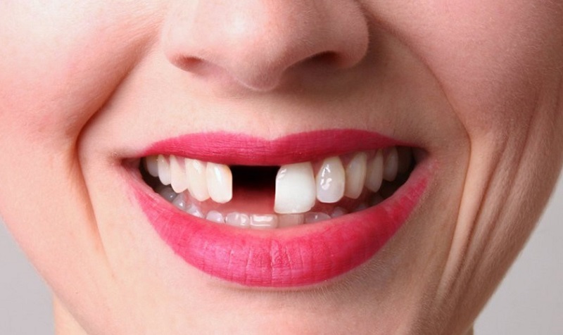 Trồng răng sứ thường được lựa chọn với trường hợp bị mất một hoặc nhiều răng