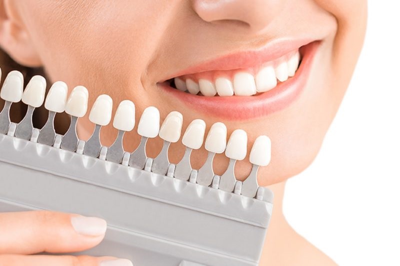 Yếu tố nào tác động tới thời gian trồng răng sứ mất bao lâu? 