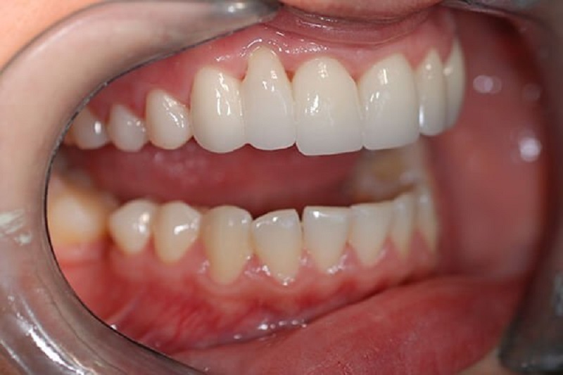 Trồng răng sứ nguyên hàm là phương pháp dùng mão răng sứ với kích thước, hình dáng, màu sắc giống với răng thật