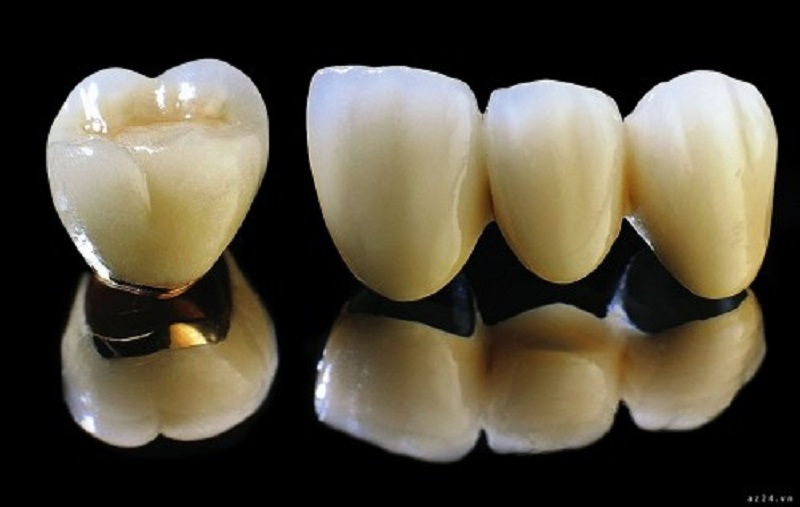 Trồng răng sứ titan giá bao nhiêu ở mỗi người sẽ có một mức giá khác nhau
