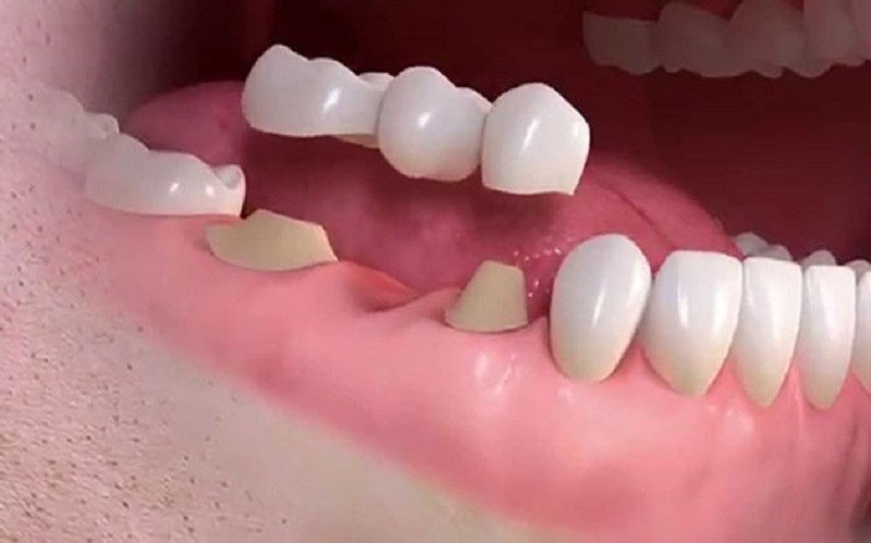 Tùy vào từng trường hợp mà có thể lựa chọn phương pháp trồng răng sứ phù hợp