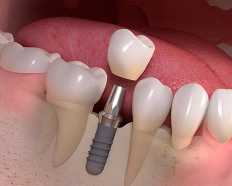 Việc trồng răng có đau hay không sẽ phụ thuộc vào nhiều yếu tố khác nhau