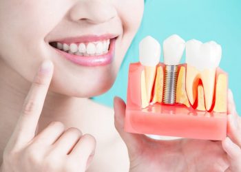 Trồng răng sứ vĩnh viễn còn được gọi là phương pháp cấy răng sứ Implant