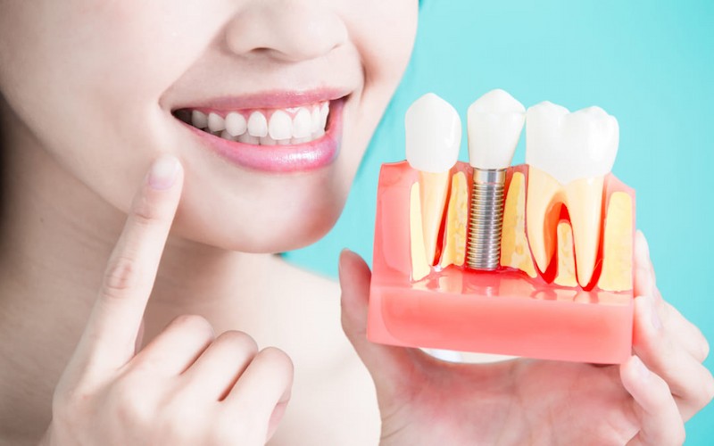 Trồng răng sứ vĩnh viễn còn được gọi là phương pháp cấy răng sứ Implant