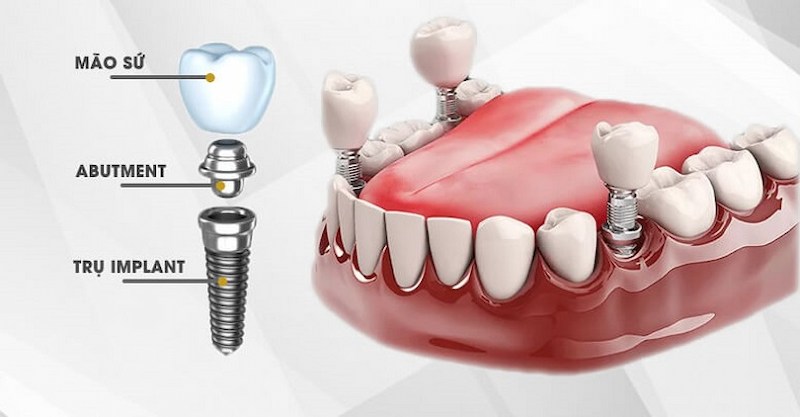 Quy trình trồng răng Implant cần cấy trụ răng trước rồi sau đó gắn mão sứ lên