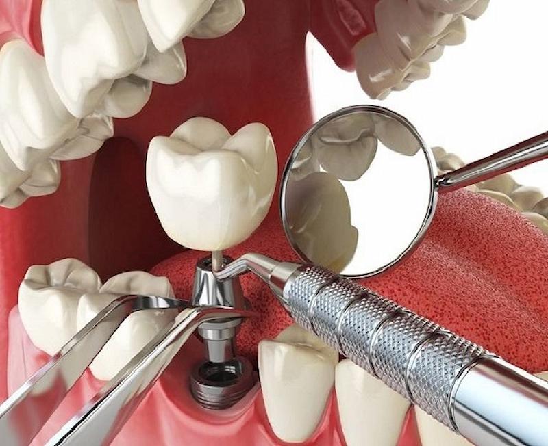 Thời gian trồng răng sứ vĩnh viễn dài hay ngắn phụ thuộc nhiều vào sức khỏe của bệnh nhân