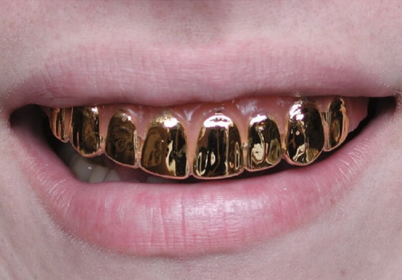Giá trồng răng vàng hiện nay dao động trong khoảng từ 10 triệu đồng đến 12 triệu đồng/ răng