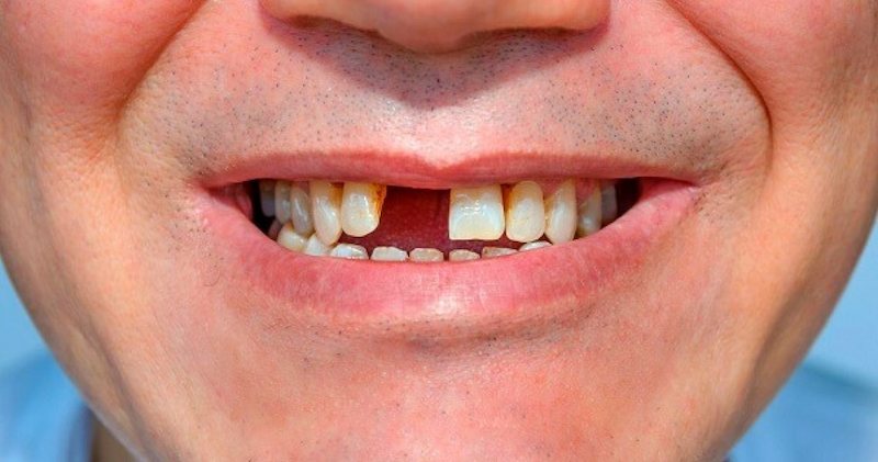 Người bị mất răng nên thực hiện trồng răng giả