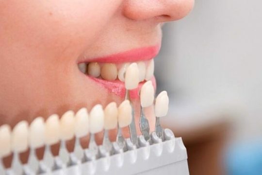 Trồng răng khểnh bằng cấy ghép implant có giá từ 16 đến 35 triệu đồng