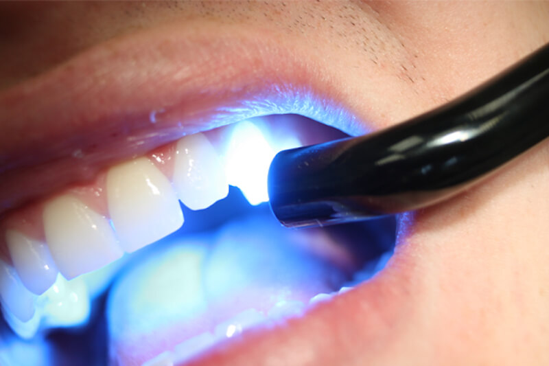 Trồng răng khểnh giá bao nhiêu với phương pháp Composite