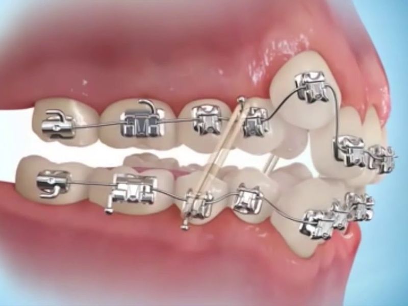 Sau khi niềng răng giữ lại răng khểnh, bạn nên vệ sinh răng miệng cẩn thận