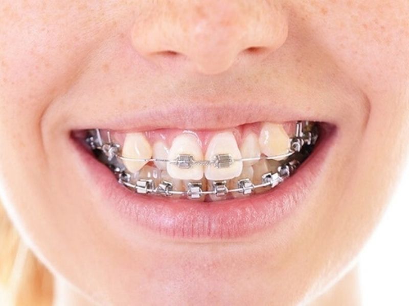 Đáp án cho câu hỏi niềng răng giữ lại răng khểnh được không là có