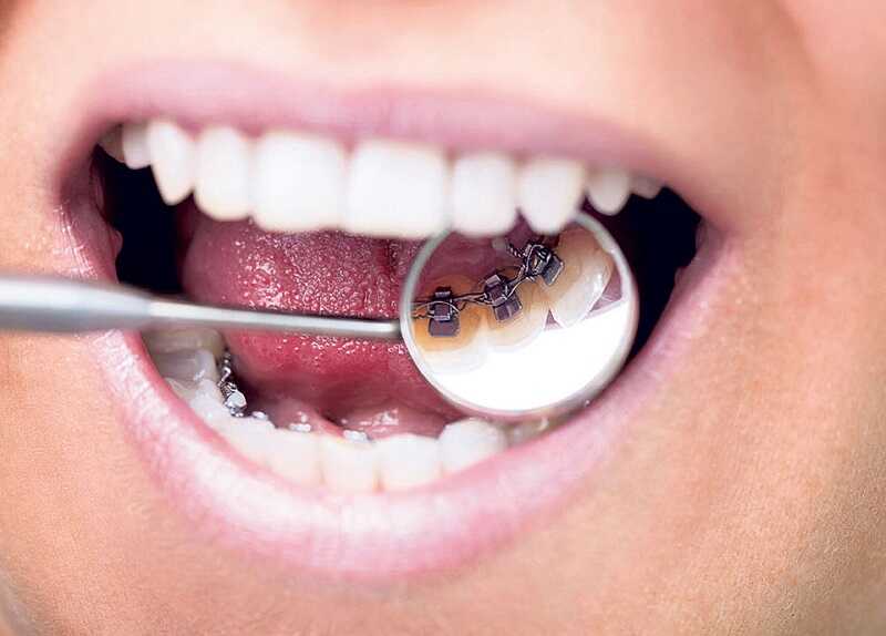 Người bệnh cần tuân thủ đúng theo quy trình niềng răng chuẩn quốc tế để đảm bảo hiệu quả