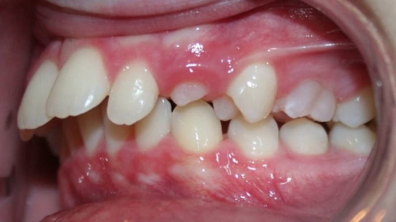 Răng hô là trường hợp bệnh lý sai khớp cắn phổ biến hiện nay
