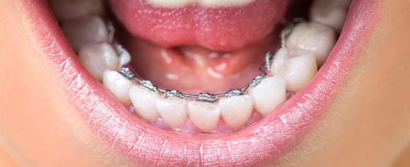 Niềng răng cố định mặt lưỡi giúp khắc phục tình trạng răng hô cằm lẹm hiệu quả
