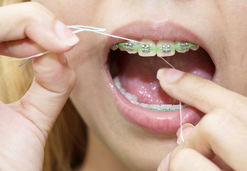 Trong quá trình niềng răng sử dụng chỉ nha khoa thay thế tăm giúp bảo vệ nướu
