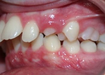 Niềng răng hô cằm lẹm là phương pháp chỉnh nha an toàn và hiệu quả nhất hiện nay