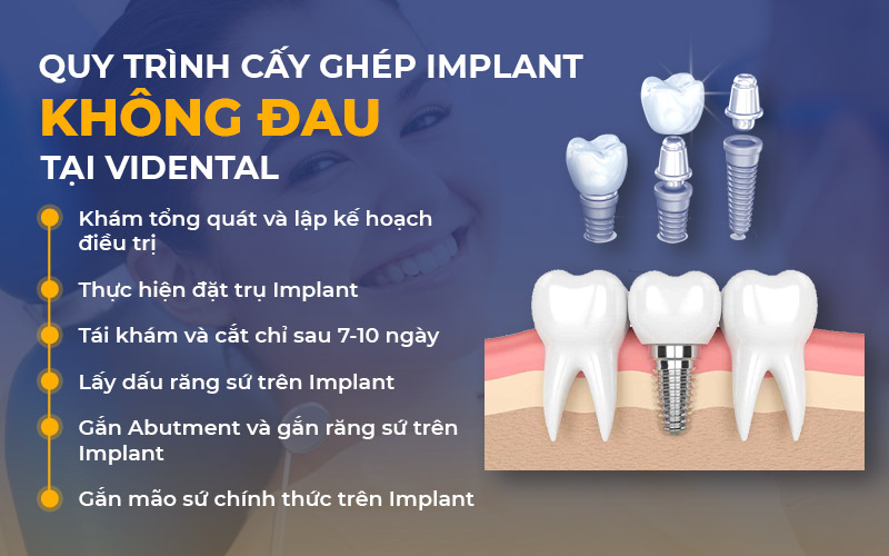 Quy trình trồng răng implant tại Vidental