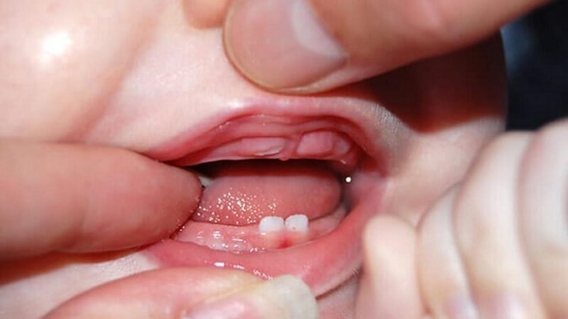 Bé sẽ bị ấm người nhẹ trong khoảng từ 1 đến 3 ngày đầu khi răng bắt đầu nhú