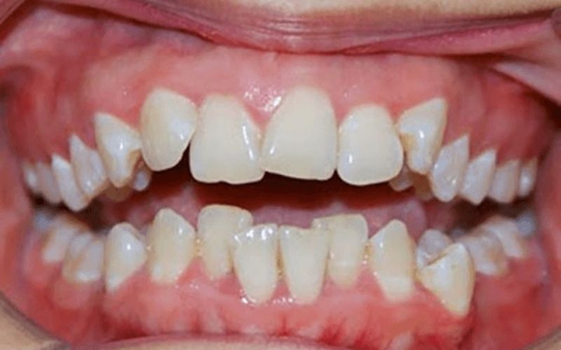 Răng lệch lạc gây nên nhiều phiến toái trong cuộc sống