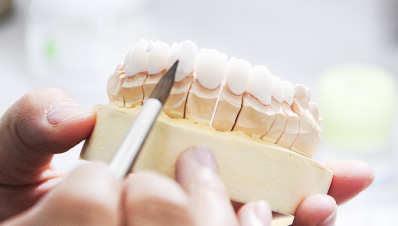 Bọc răng sứ không kim loại được các chuyên gia đánh giá cao về tính thẩm mỹ, độ bền