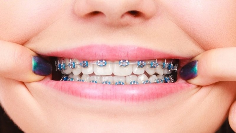 Niềng răng 2 hàm được áp dụng cho tất cả các trường hợp răng mọc sai vị trí trên cung hàm