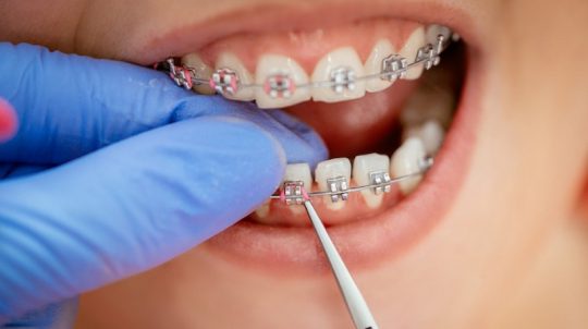 Chi phí niềng răng 2 hàm khá cao do đó bạn nên tìm hiểu kỹ trước khi áp dụng